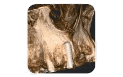 lastra denti alta definizione