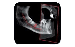 Tomografia computerizzata a fascio conico (CBCT) dentale che mostra una sezione della mandibola con una linea rossa evidenziata che traccia il canale del nervo mandibolare.