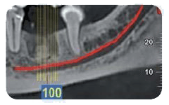 Tomografia computerizzata a fascio conico (CBCT) dentale che mostra una sezione trasversale della mandibola con una linea rossa che traccia il canale del nervo mandibolare e linee di griglia verticali.