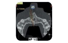 Una scansione CBCT dentale che mostra una vista in sezione trasversale del mascellare superiore con il sito implantare pianificato, etichettato 