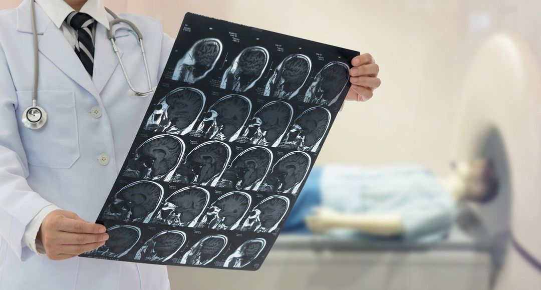 Un operatore sanitario tiene in mano una pellicola per risonanza magnetica cerebrale, mentre sullo sfondo si vede un paziente sdraiato in una macchina per la risonanza magnetica.