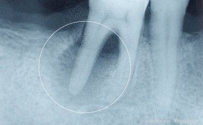 Wurzelbehandlung: Entzündung an der Wurzel eines abgestorbenen Zahnes im Röntgenbild