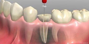 Wurzelbehandlung VS-Schwenningen: Eigene Zähne erhalten und Geld sparen