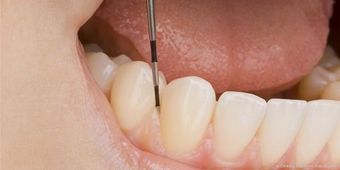 Parodontitis-Behandlung Zahnarzt VS-Schwenningen