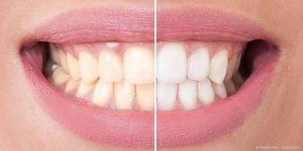 Schöne weiße Zähne mit Bleaching (Zahnaufhellung), Veneers und mehr