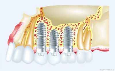 Zahnimplantate: So fest wie eigene Zähne
