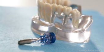 Zahnimplantate Villingen-Schwenningen: So fest wie eigene Zähne