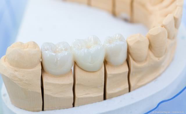 Ästhetische Zahnbrücke aus reiner Keramik Ästhetische Zahnbrücke aus reiner Keramik