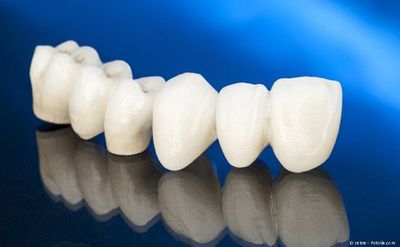 Zahnbrücke zum Ersatz fehlender Zähne