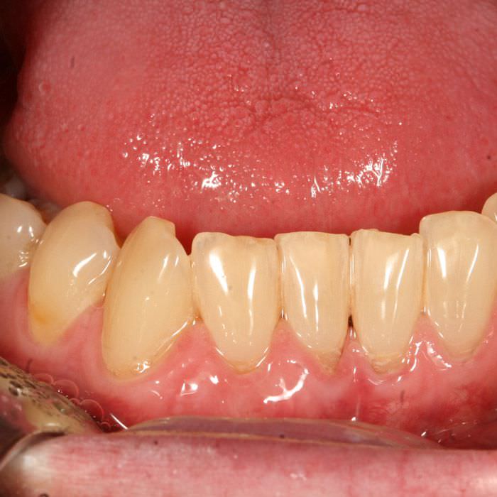 Nach Zahnfleischtransplantation