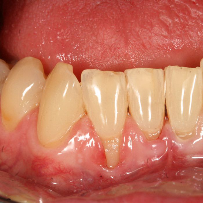 Vor Zahnfleischtransplantation
