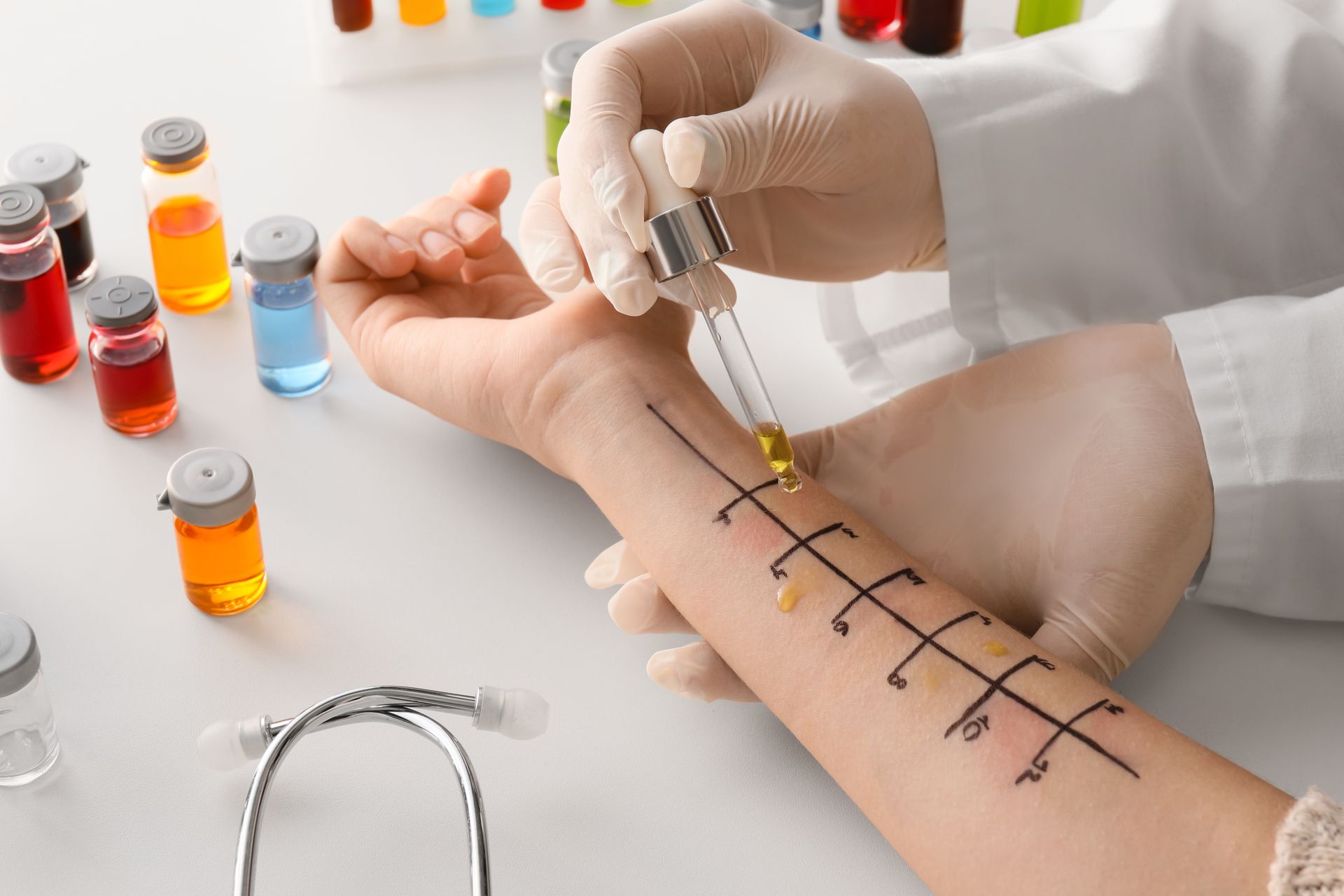 Allergy skin patch test with dropper applying allergen liquid on patient's forearm grid. 
