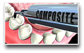 Composite Filling