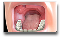 Immediate Denture