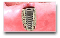 Implant Crown and Bridge