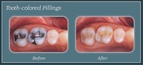 Tooth-colored Fillings
