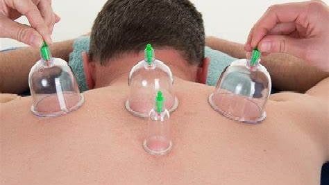 a man is getting cupping therapy on his back .