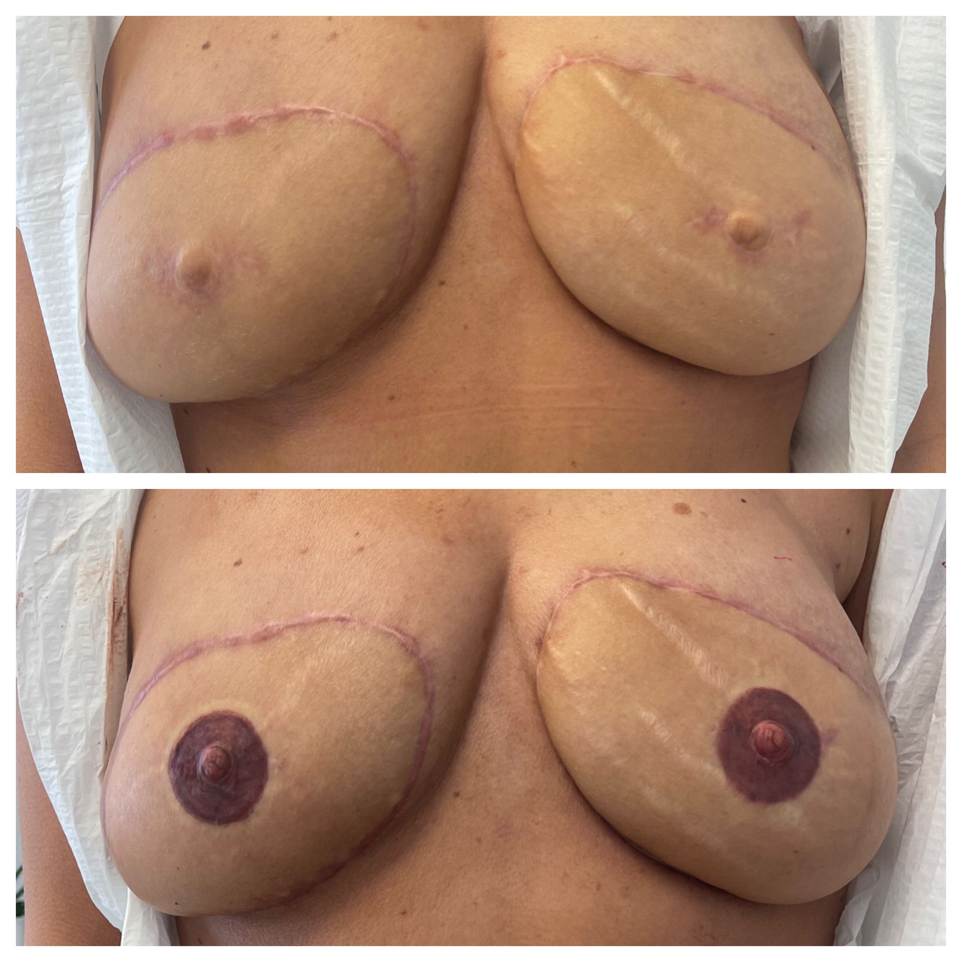 breast cancer nipple tattoo sample before and after 26