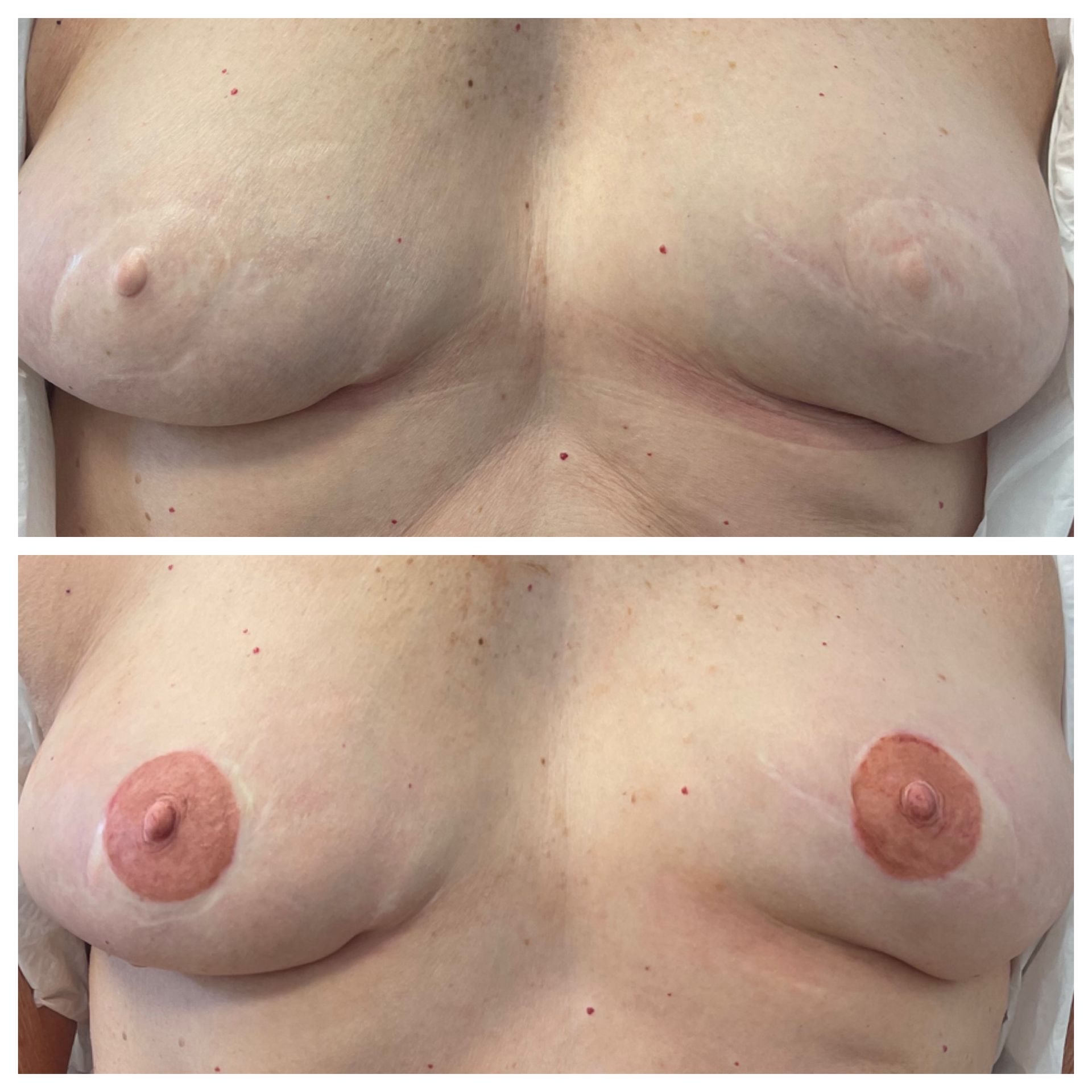 breast cancer nipple tattoo sample before and after 25