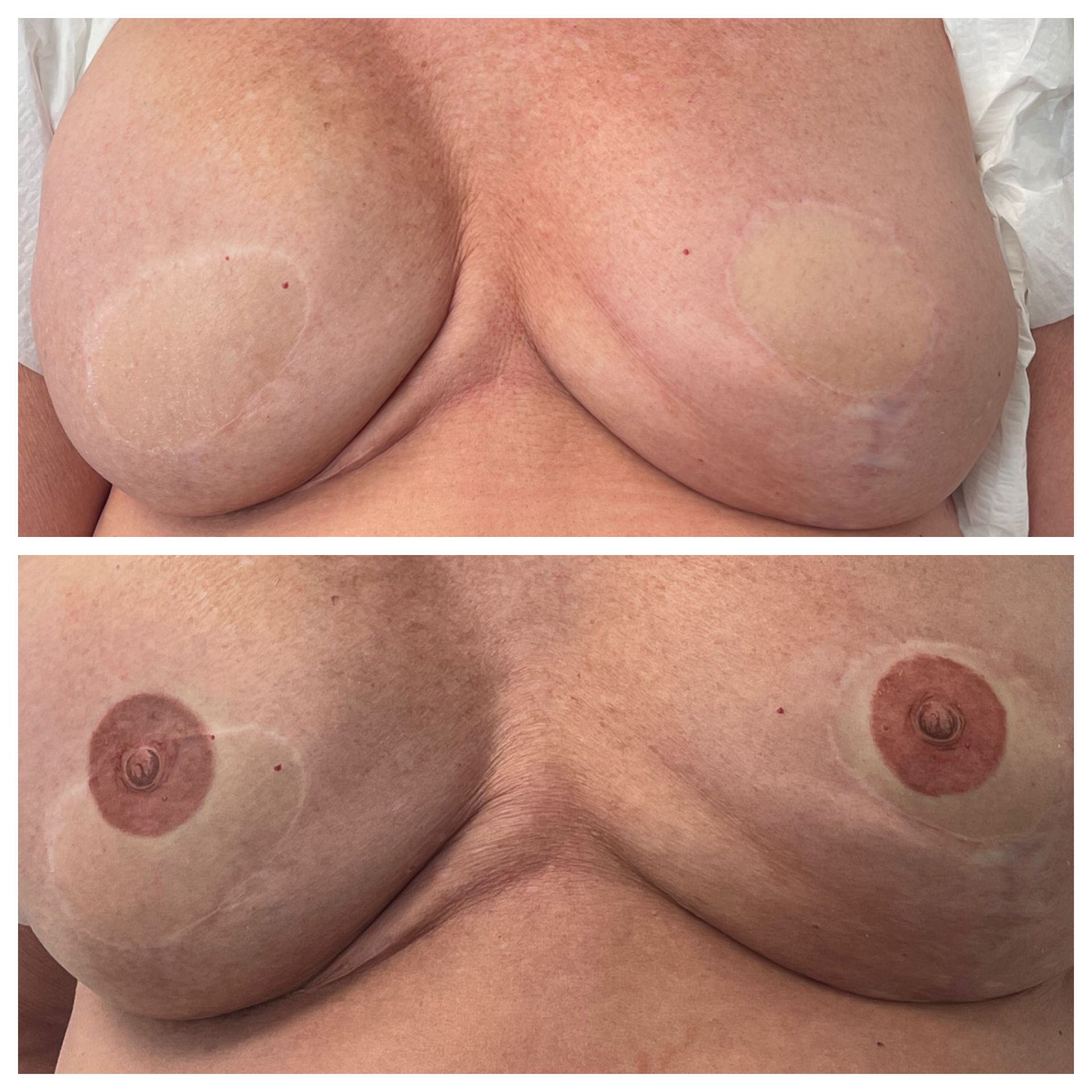 breast cancer nipple tattoo sample before and after 24
