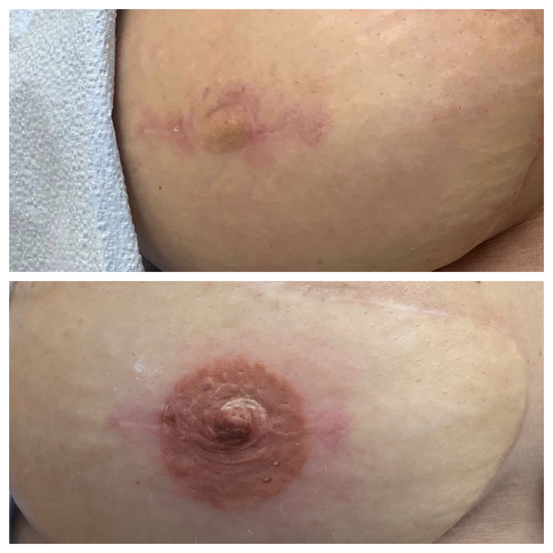 breast cancer nipple tattoo sample before and after 21