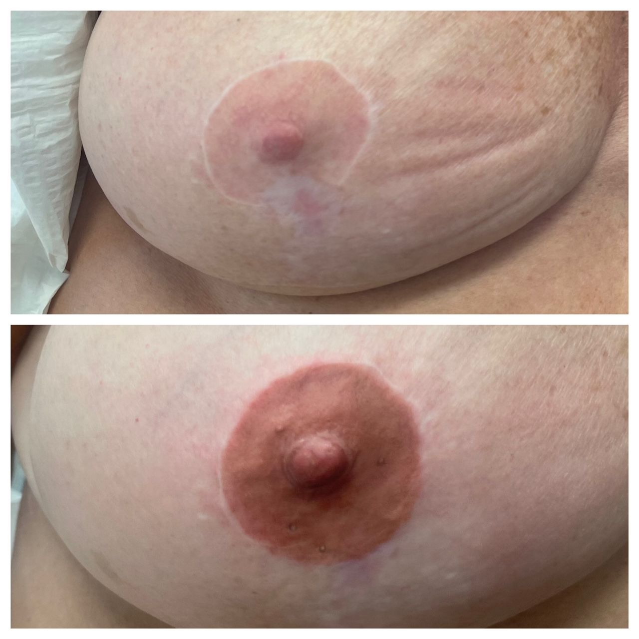 breast cancer nipple tattoo sample before and after 20