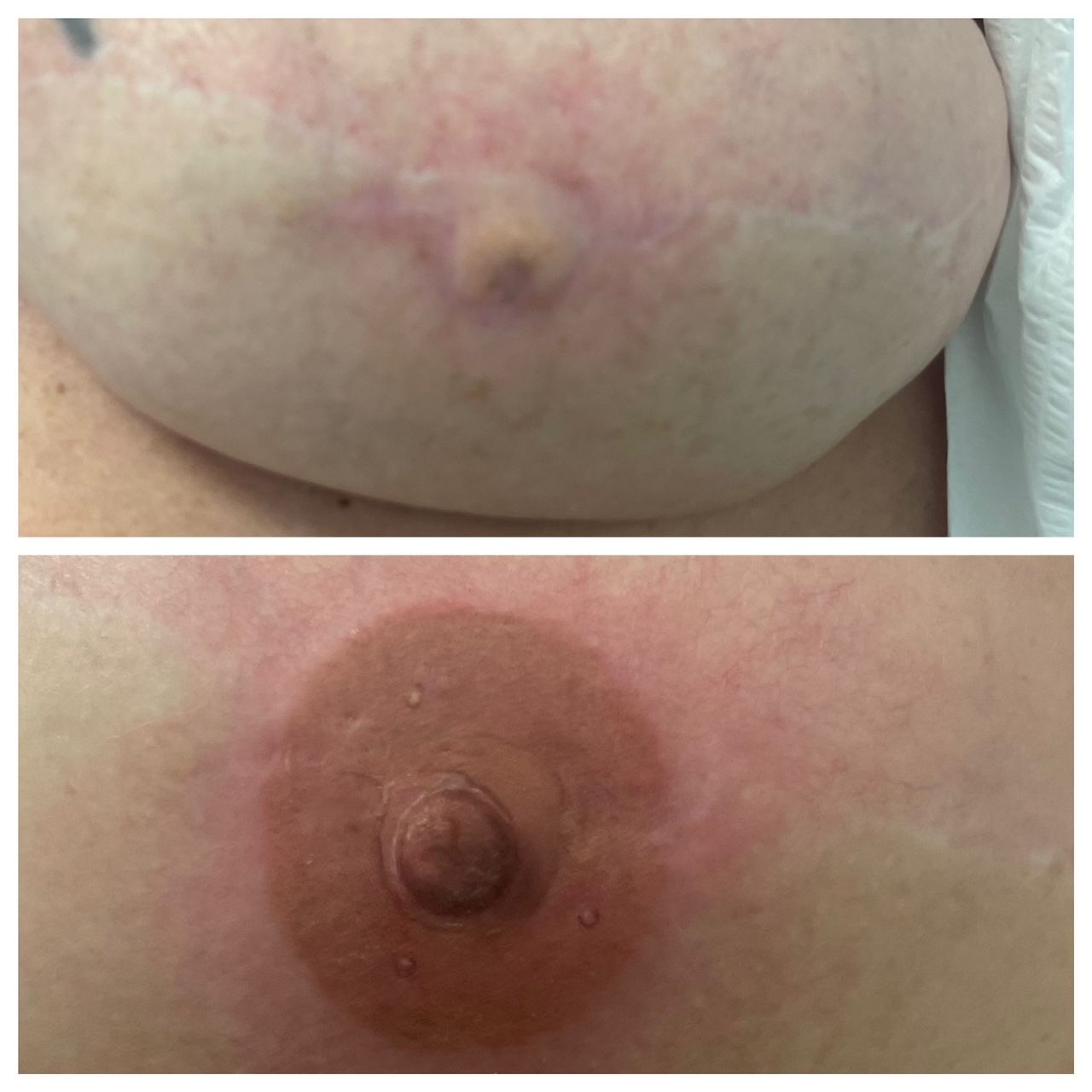 breast cancer nipple tattoo sample before and after 19
