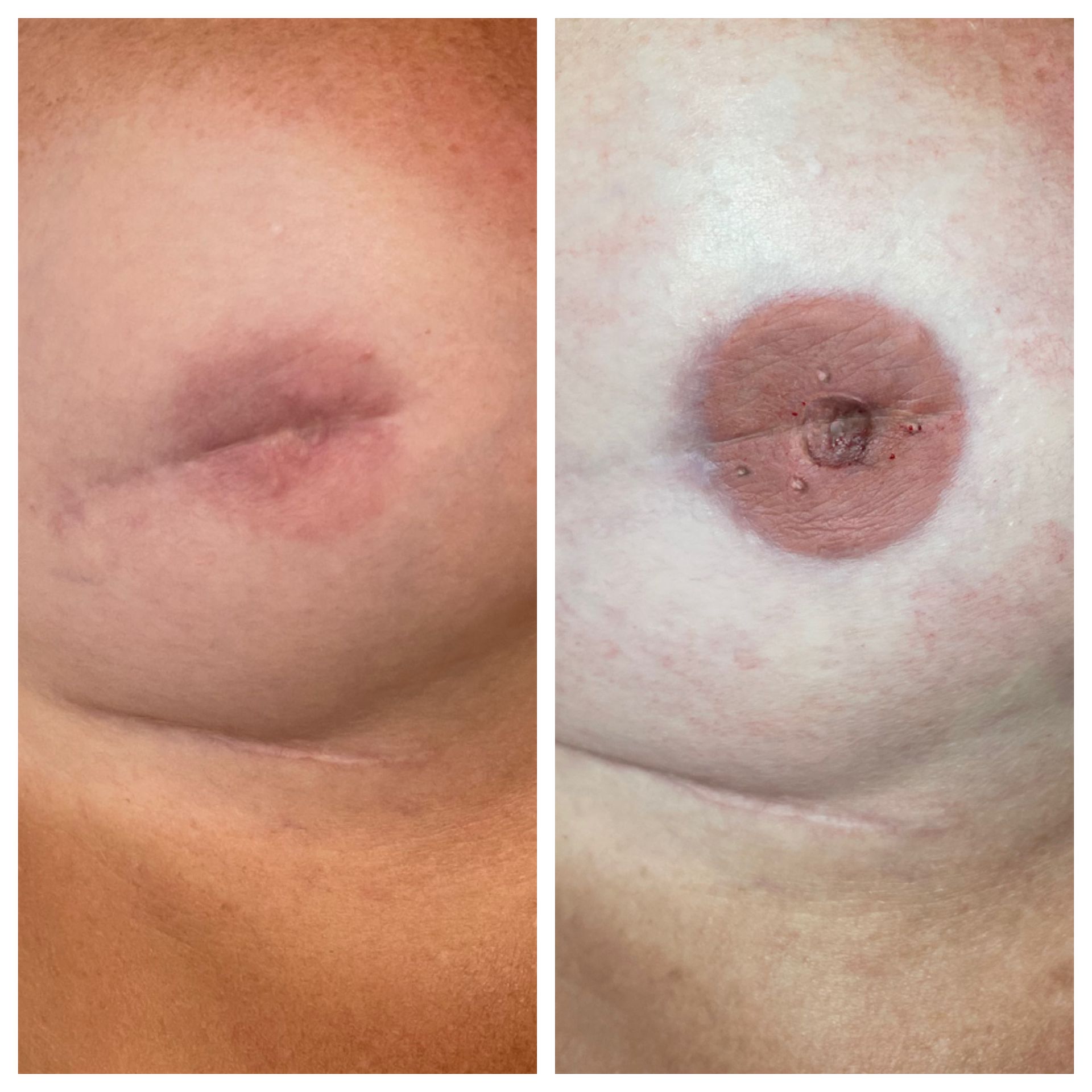breast cancer nipple tattoo sample before and after 17