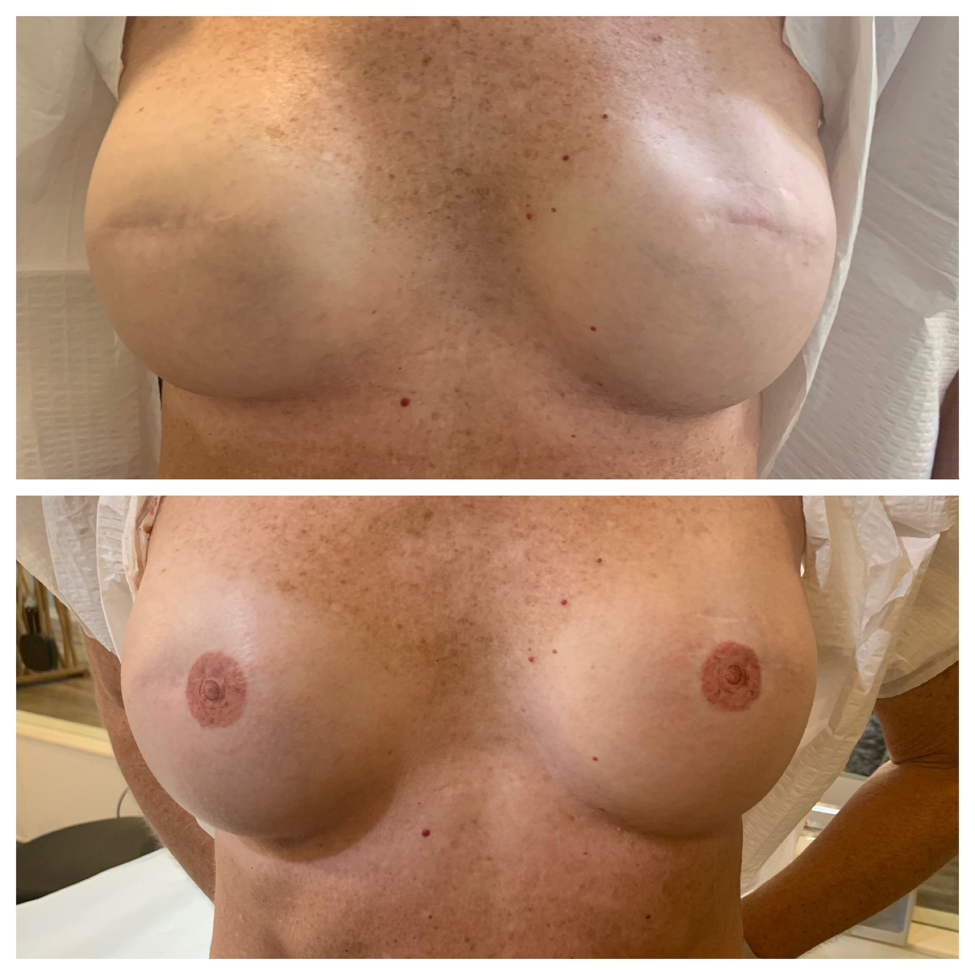breast cancer nipple tattoo sample before and after 18