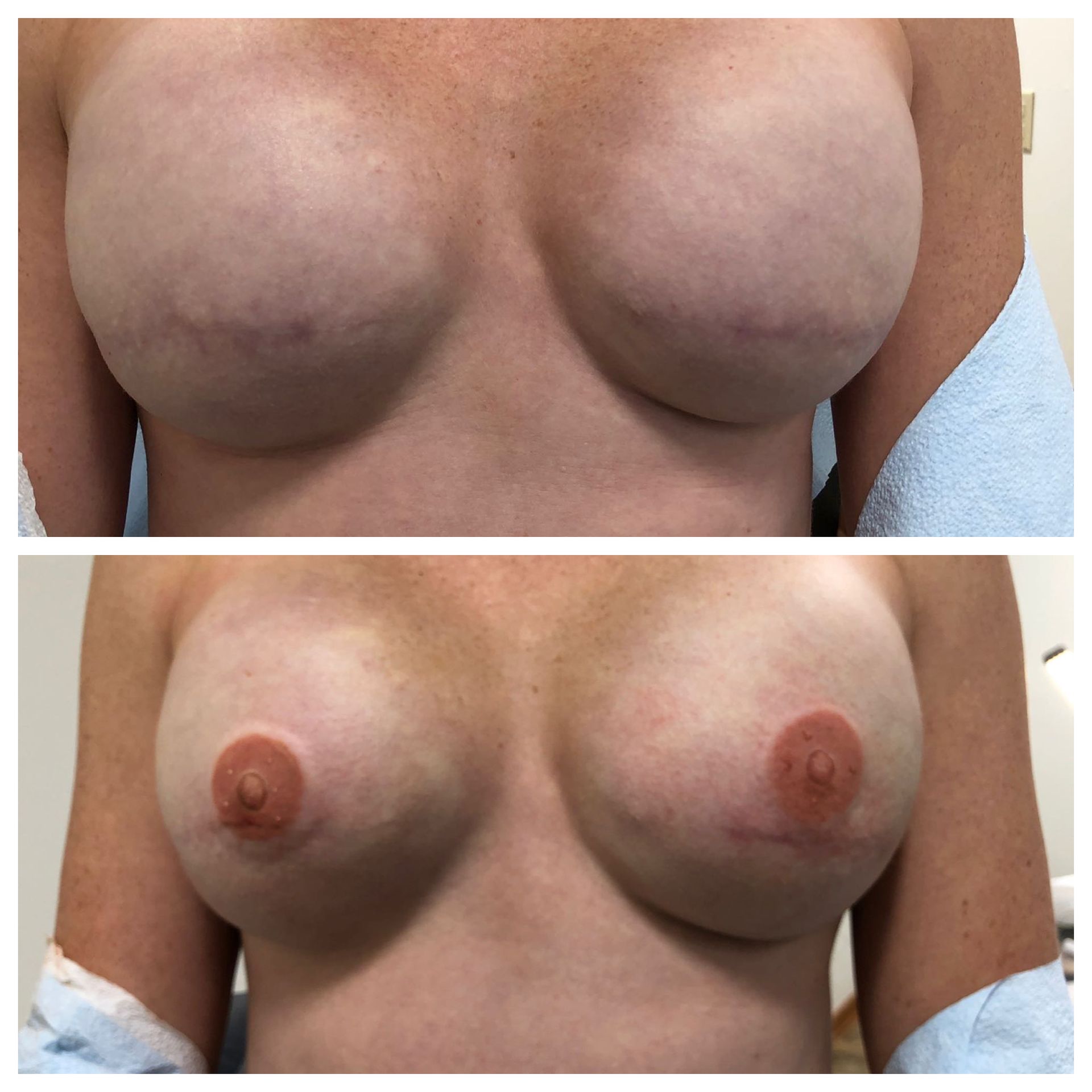 breast cancer nipple tattoo sample before and after 15