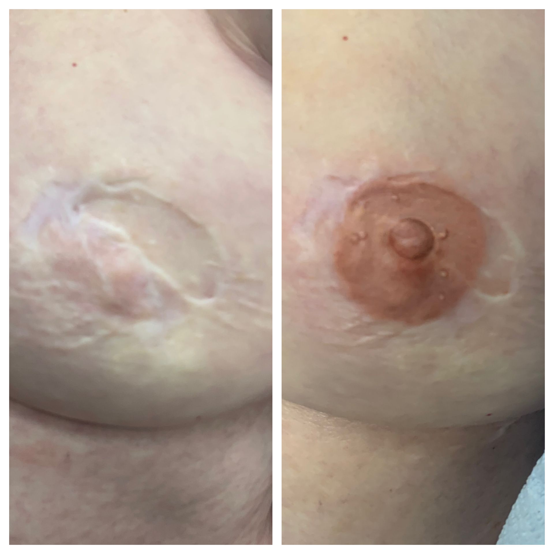 breast cancer nipple tattoo sample before and after 10