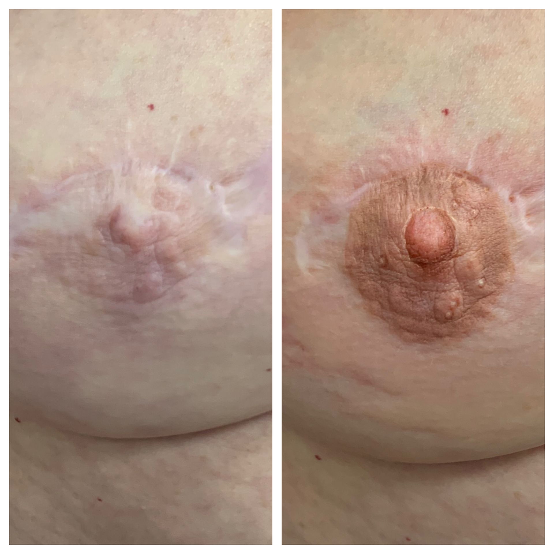 breast cancer nipple tattoo sample before and after 12