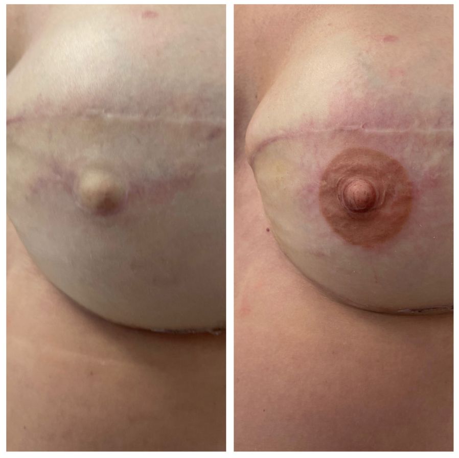 breast cancer nipple tattoo sample before and after 1