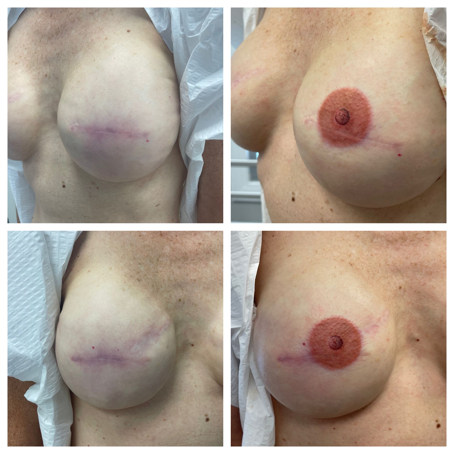 breast cancer nipple tattoo sample before and after 14