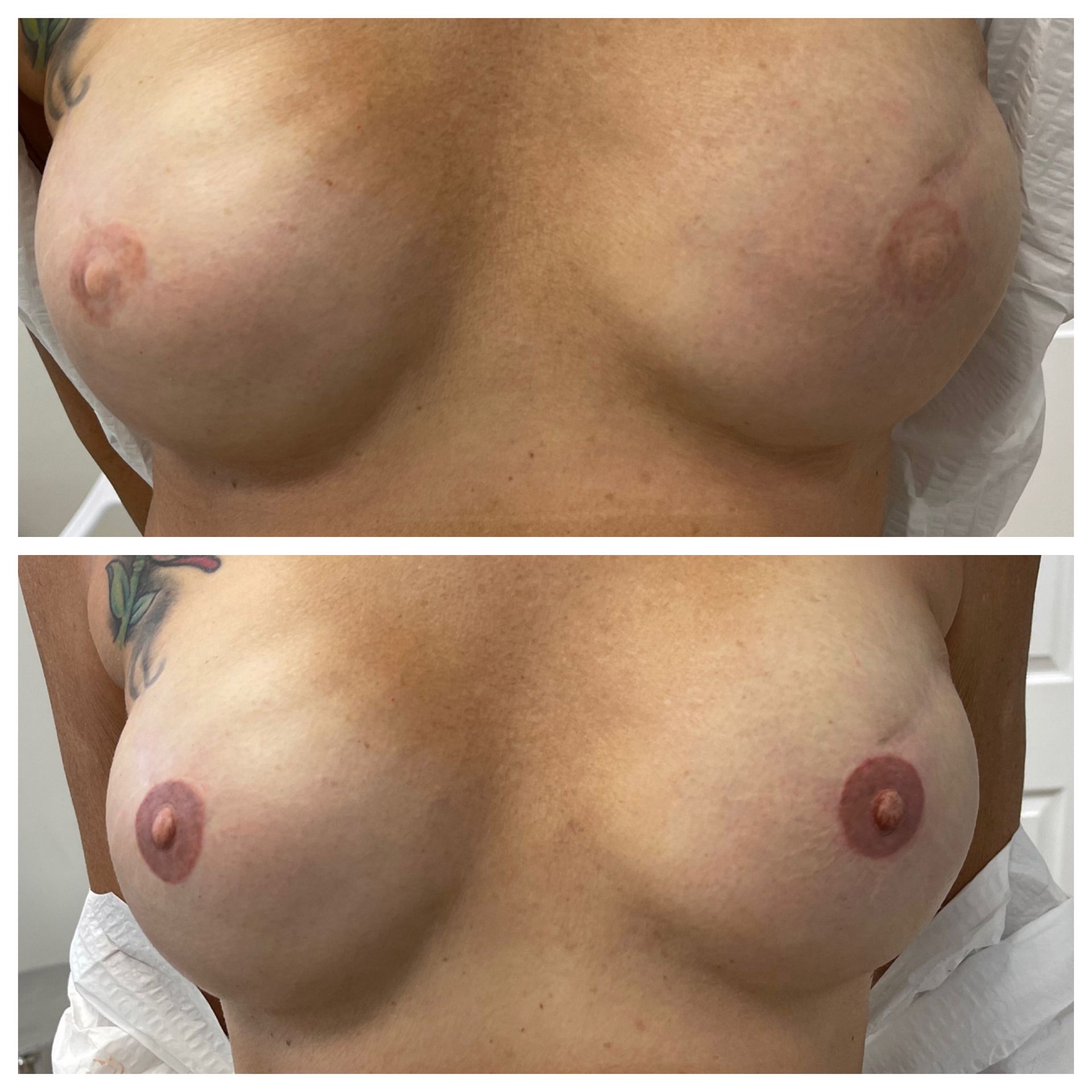 breast cancer nipple tattoo sample before and after 3