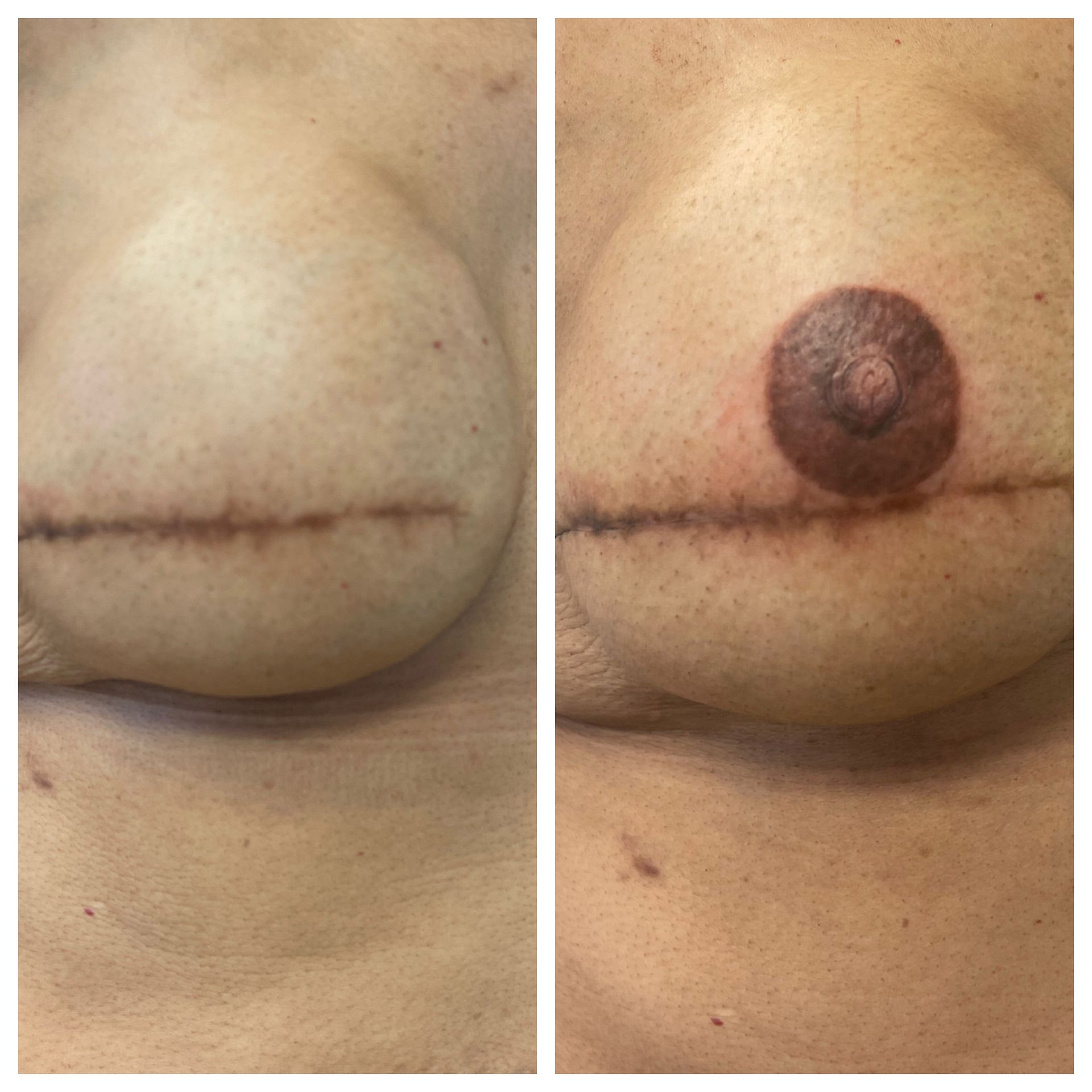 breast cancer nipple tattoo sample before and after 5