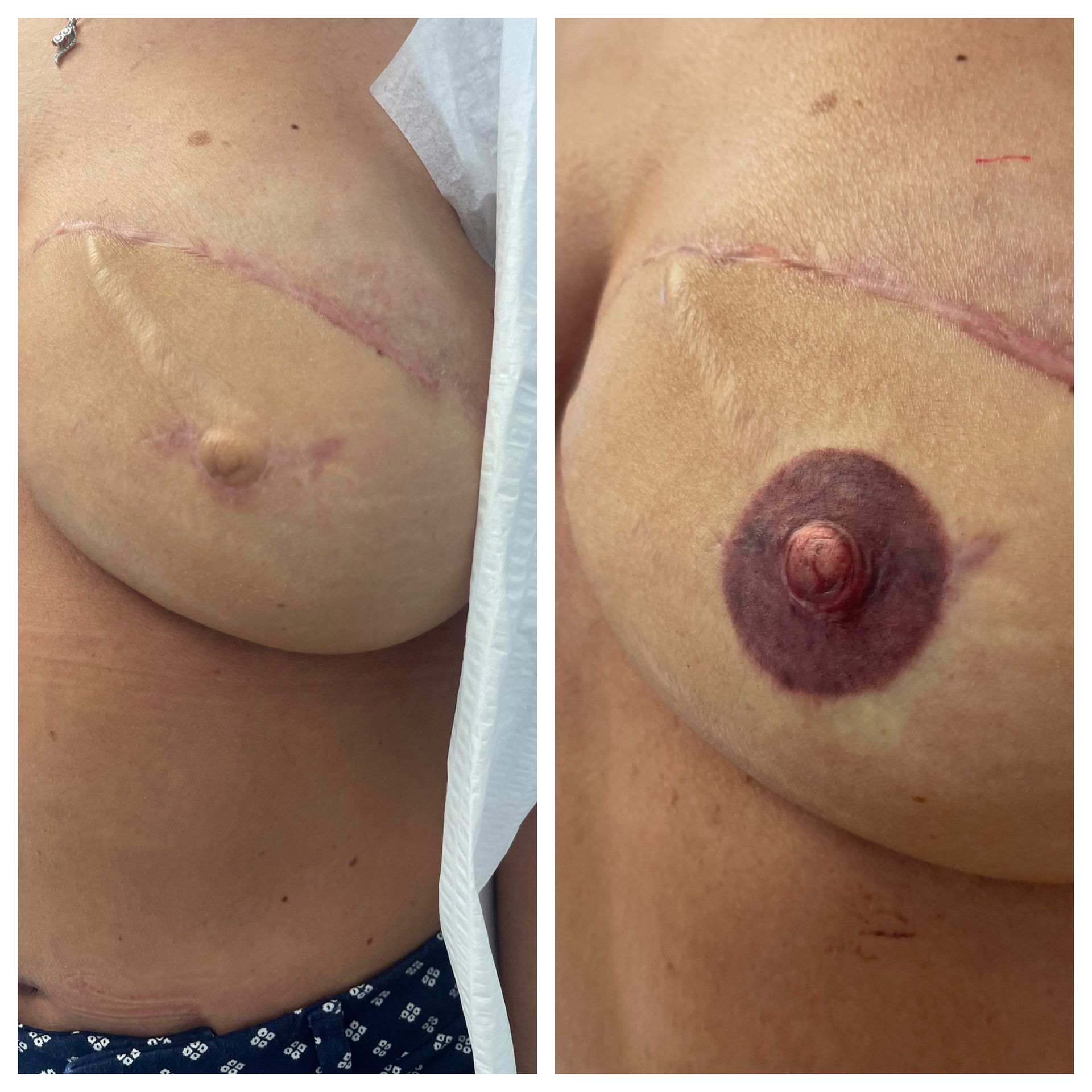 breast cancer nipple tattoo sample before and after 4