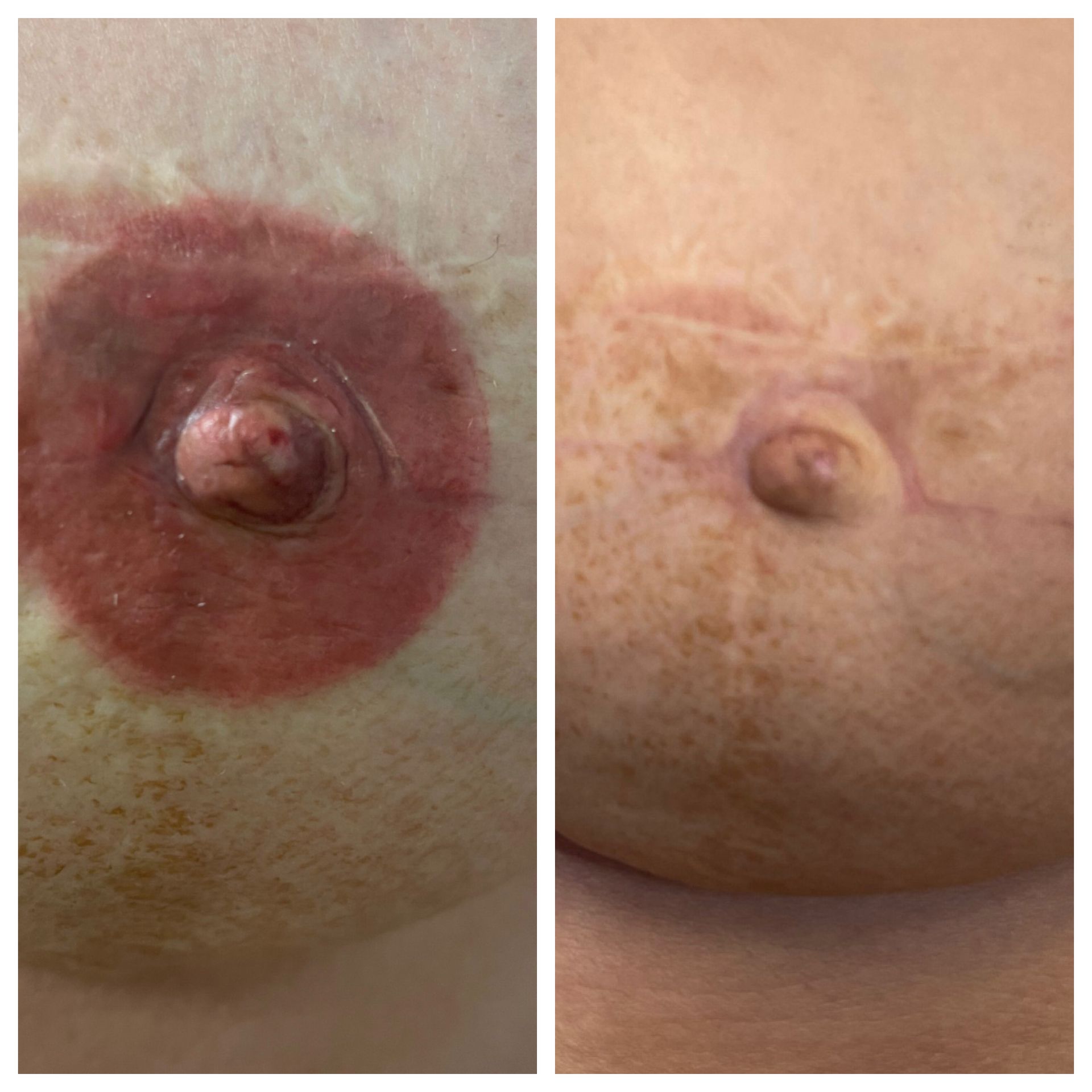 breast cancer nipple tattoo sample before and after 6
