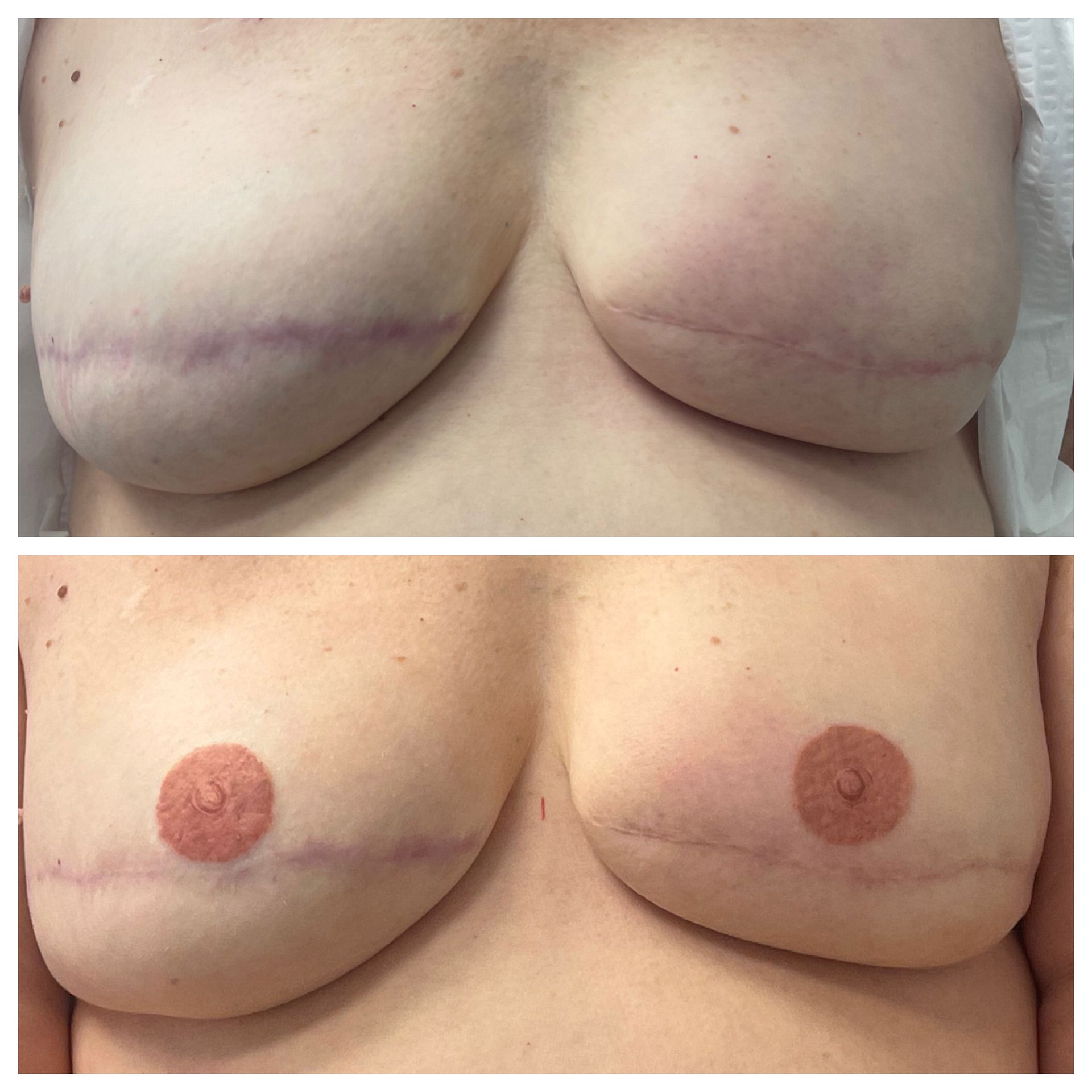 breast cancer nipple tattoo sample before and after 7