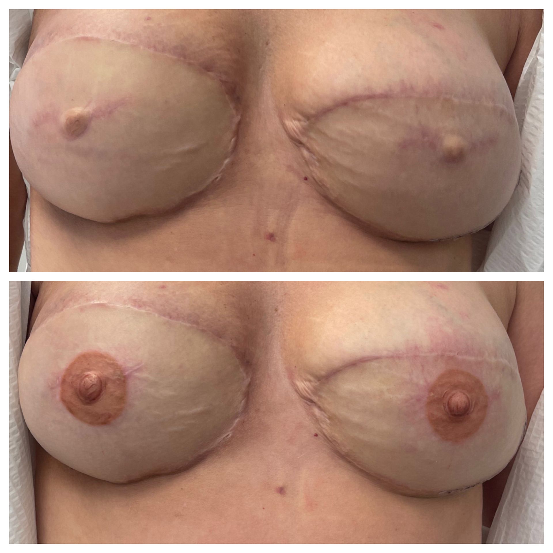 breast cancer nipple tattoo sample before and after 8