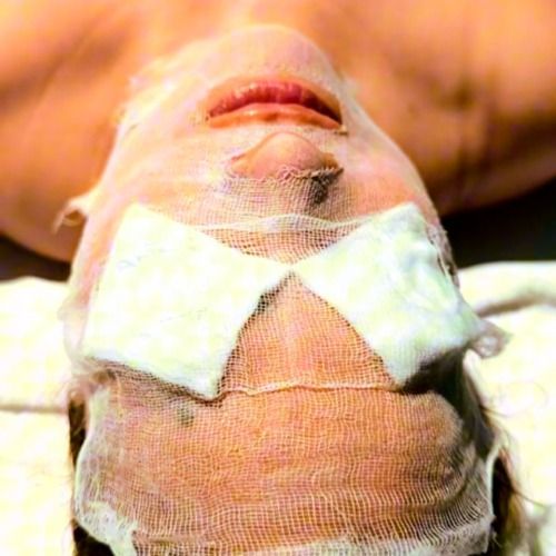 Person's face wrapped in gauze after a medical procedure, with pads over the eyes and mouth visible.