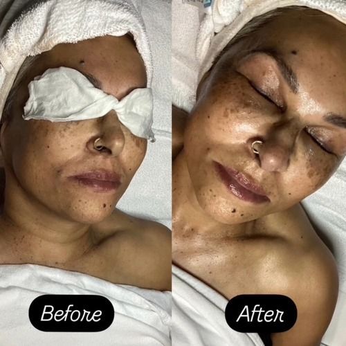 Side-by-side: Woman with skin imperfections before/after facial treatment. Darker skin with freckles, eyes closed, towel on head.