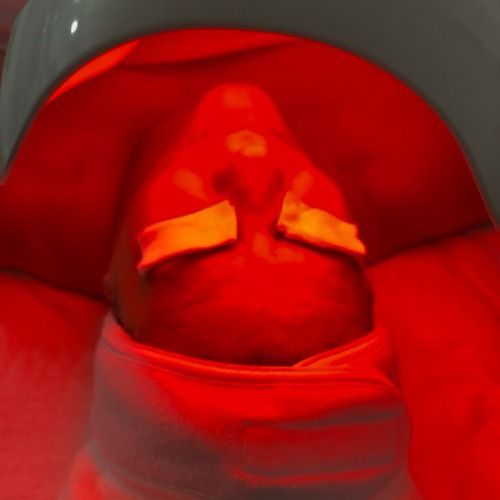 Newborn baby under phototherapy lamp with eye protection.