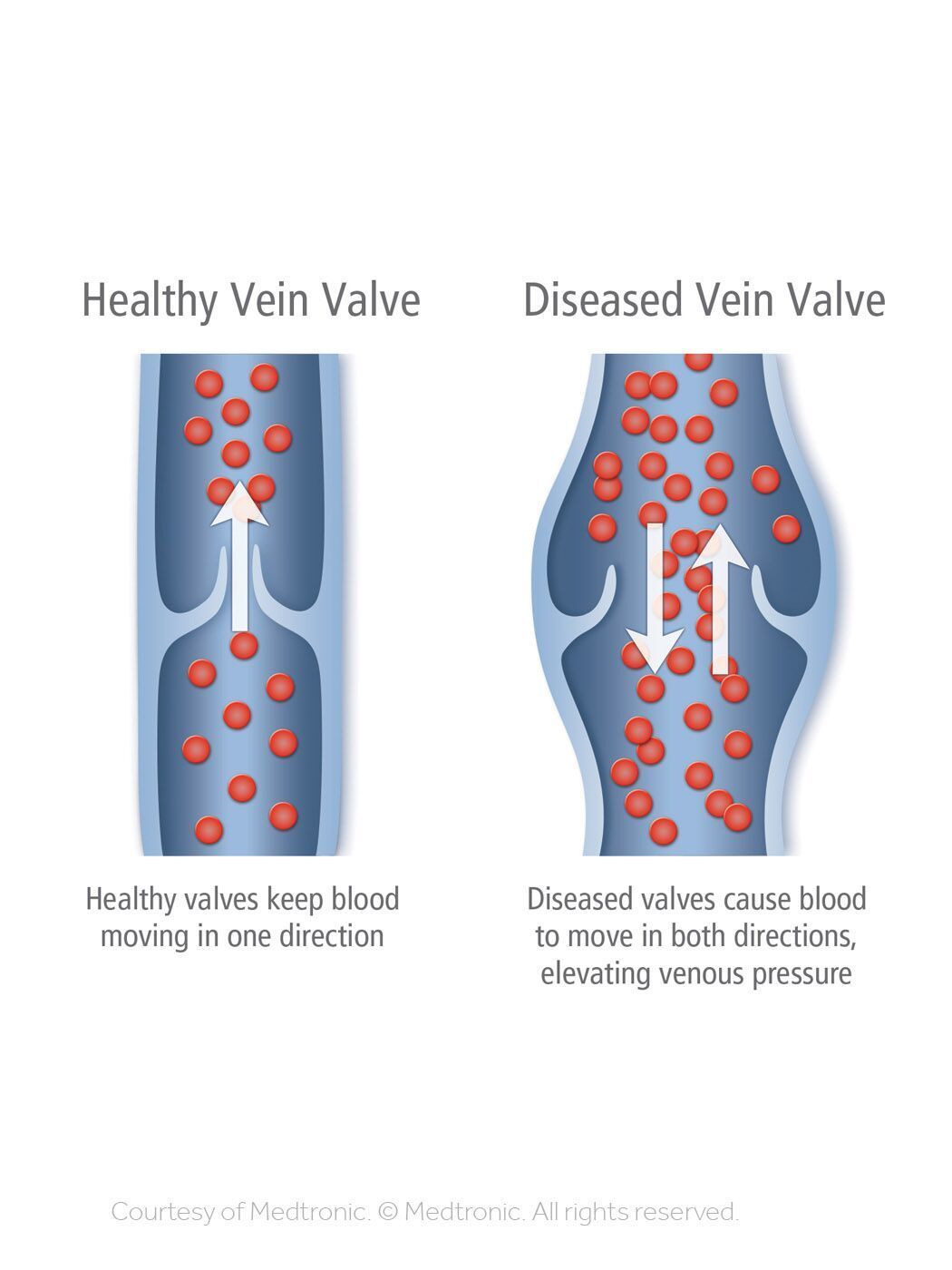 healthy vs diseased vein valve diagram