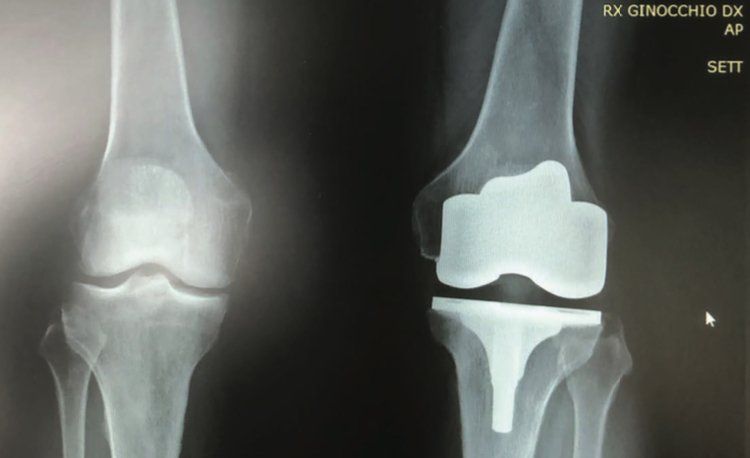 protesi di ginocchio