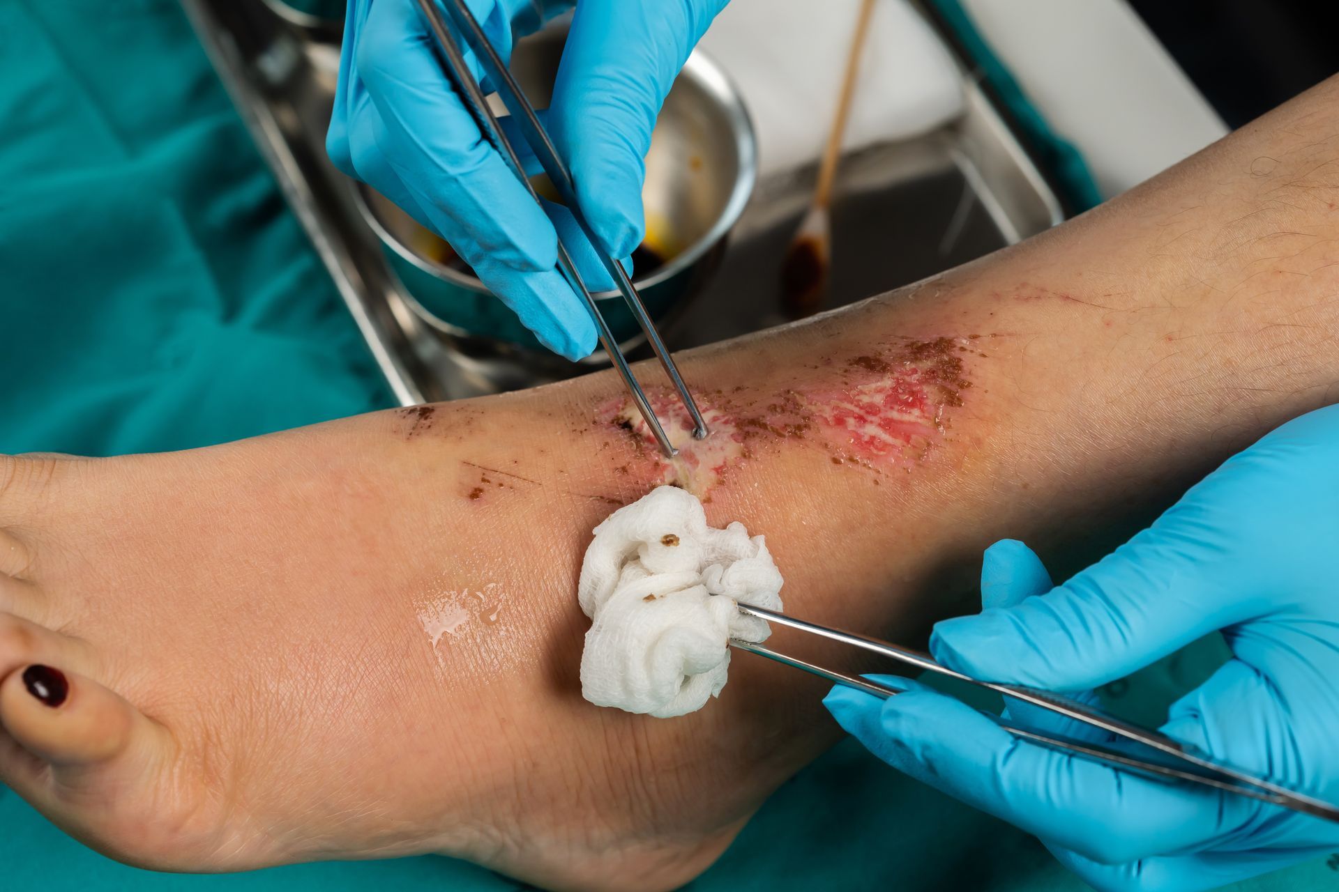 Medical gloved hands cleaning a scraped ankle with gauze and forceps