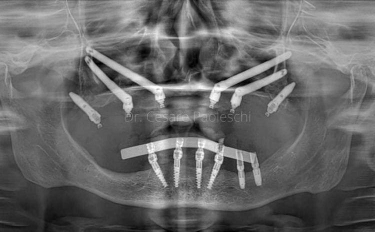 corso implantologia zigomatica