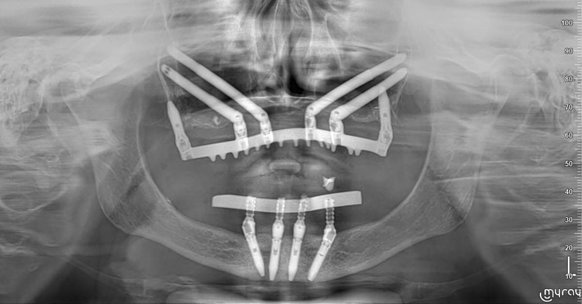 impianti zigomatici corso