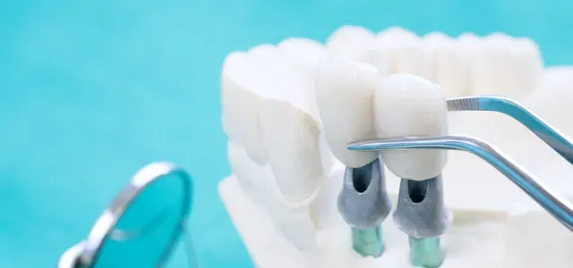 Implant Prosthodontics Or Prosthetic - Atlanta, GA - Downtown Dental Center
