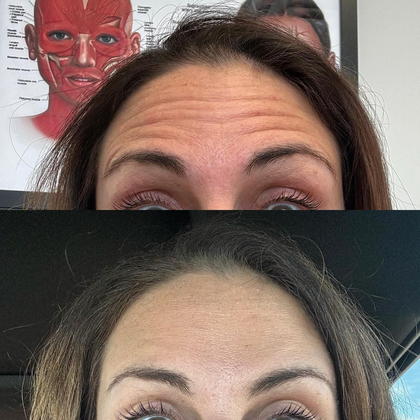 A before and after picture of a woman's forehead